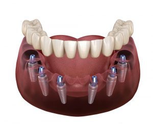 Protesi dentale: arcata su 6 impianti