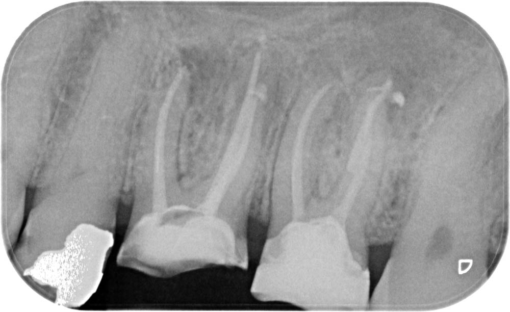Radici denti per servizio di endodonzia