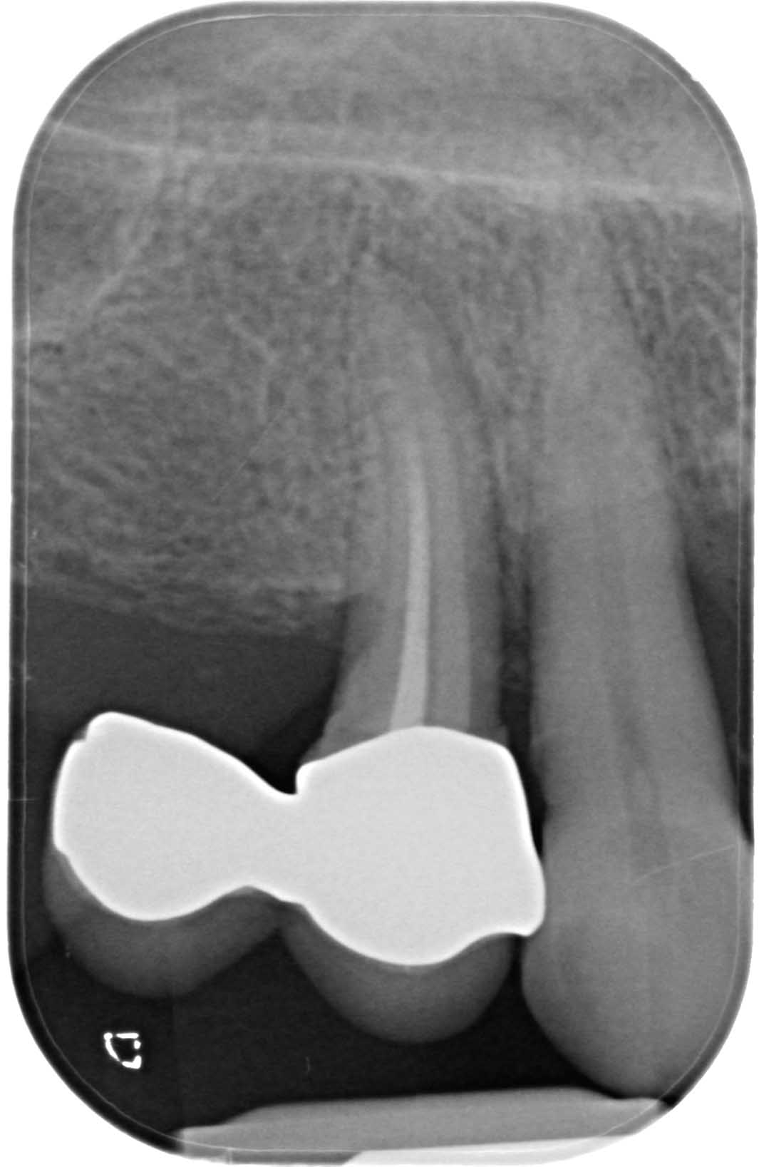 Radiografia dentale per endodonzia