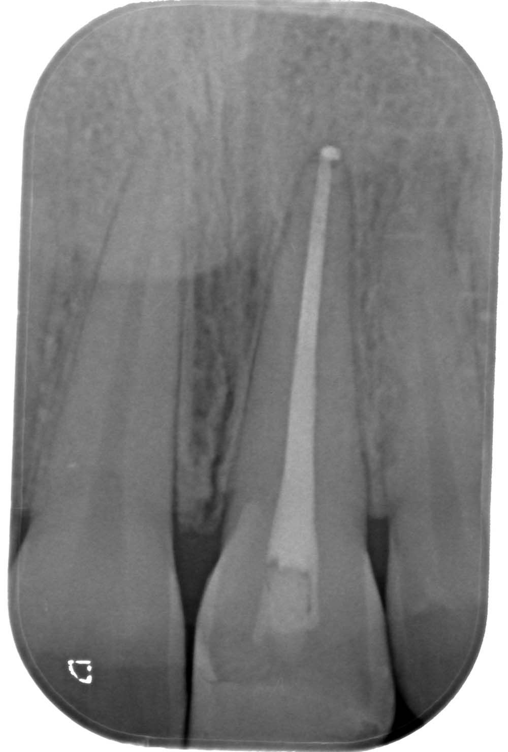 Radice dente endodonzia