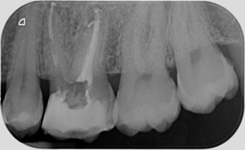 Caso clinico di endodonzia dentale