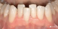 disallineamenti-ortodonzia-studio-amosso-dentista-biella