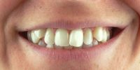 disarmonie-estetiche-ortodonzia-studio-amosso-dentista-biella