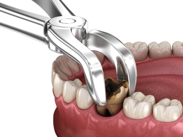 Strumenti Chirurgici Oral Medentra Kit Elevatori Dentali Per Estrazione - 8 Pezzi In Acciaio Inox, Per Chirurgia Orale, Marca Medentra Dentifricio Mentadent - Foto 14