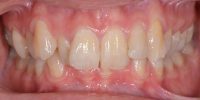 malocclusione-dentale-ortodonzia-studio-amosso-dentista-biella